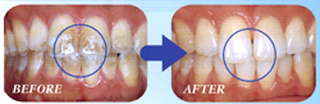 P.M.T.C.の効果　きれいな歯を保つ